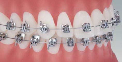 ortodoncja knurow aparat samoligaturujacy